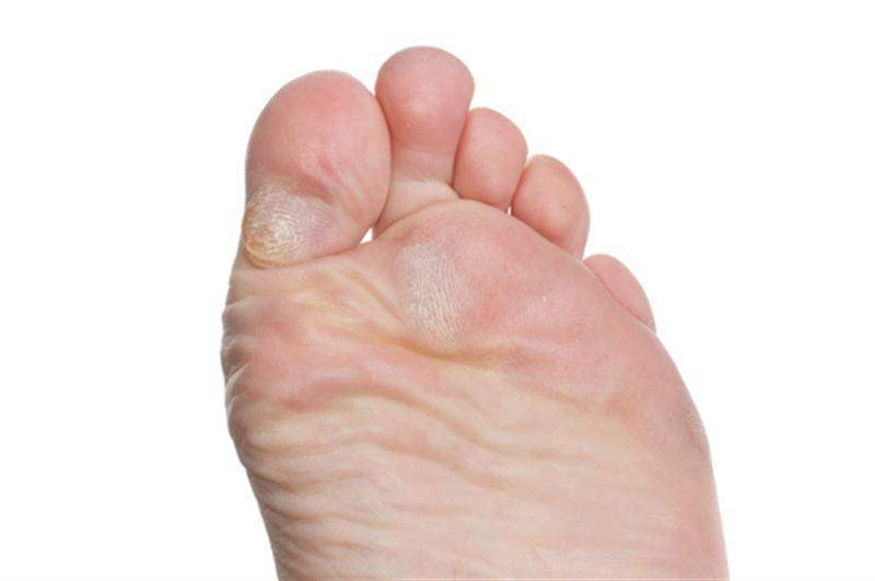 calosidades e úlceras nos pés